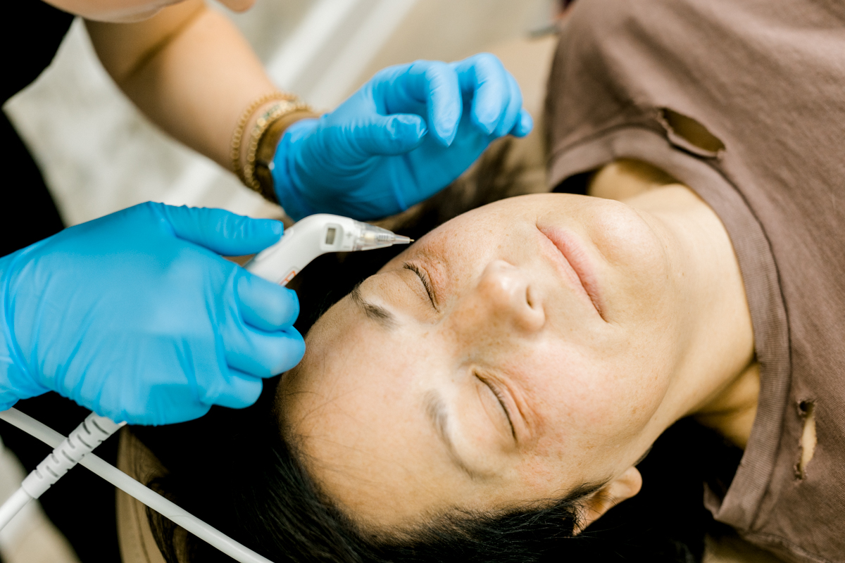 microneedling treatment on patient