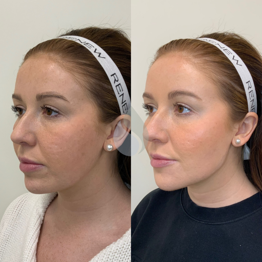 picture of woman with fillers, before and after, juvederm filler, 